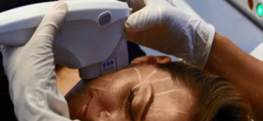 Palisades Vein Center- woman undergoing ulthera
