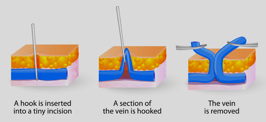 Palisades Vein Center- depiction of ambulatory phlebectomy - Palisades Vein Center and Medical Spa