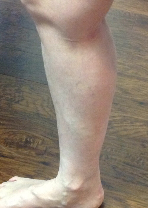 Palisades Vein Center- leg after vein treatment